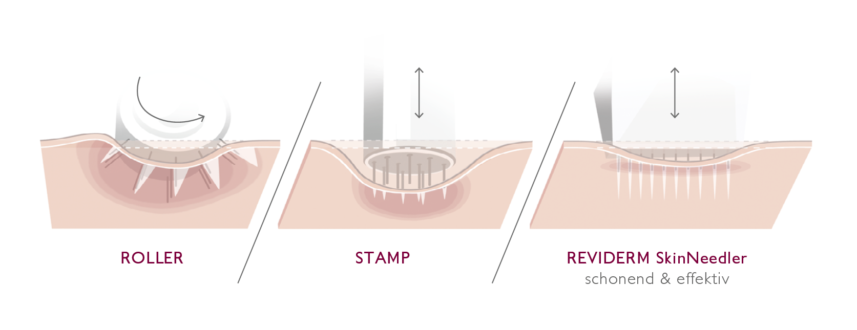 reviderm-cosmetics-berlin-kosmetik-dermokosmetik-micro-needling-skinneedler-vergleich