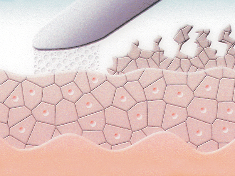 Die Mikrodermabrasion trägt Hornzellen ab.
