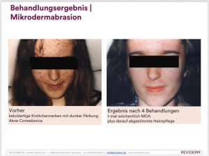 Microdermabrasion Behandlungsergebnis Reviderm