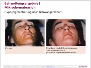 Microdermabrasion Behandlungsergebnis Reviderm