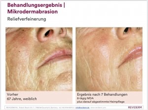 Microdermabrasion Behandlungsergebnis Reviderm