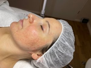 Microdermabrasion Reviderm nachher links