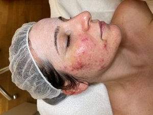 Microdermabrasion Reviderm vorher rechts