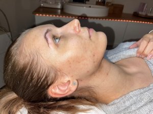 microneedling nachher rechts