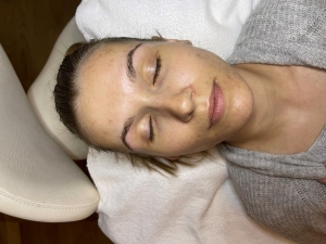 microneedling nachher vorn