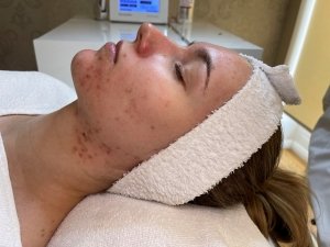 microneedling vorher links