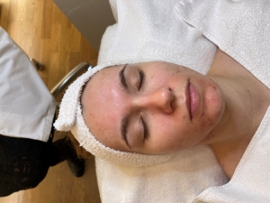 microneedling vorher vorn