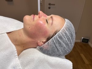 ultraschall couperose nachher rechts